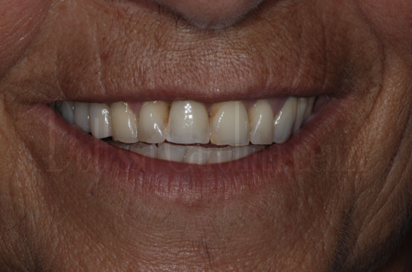 Il sorriso dopo l?impianto dente singolo